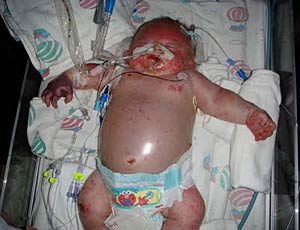 В Хакасии младенец умер от прививки против гепатита
