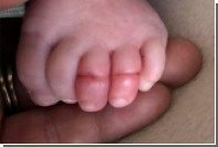 Младенец почти лишился пальцев ног из-за волос матери