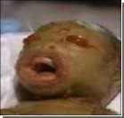 Родился ребенок с вывернутыми наизнанку глазами. Фото